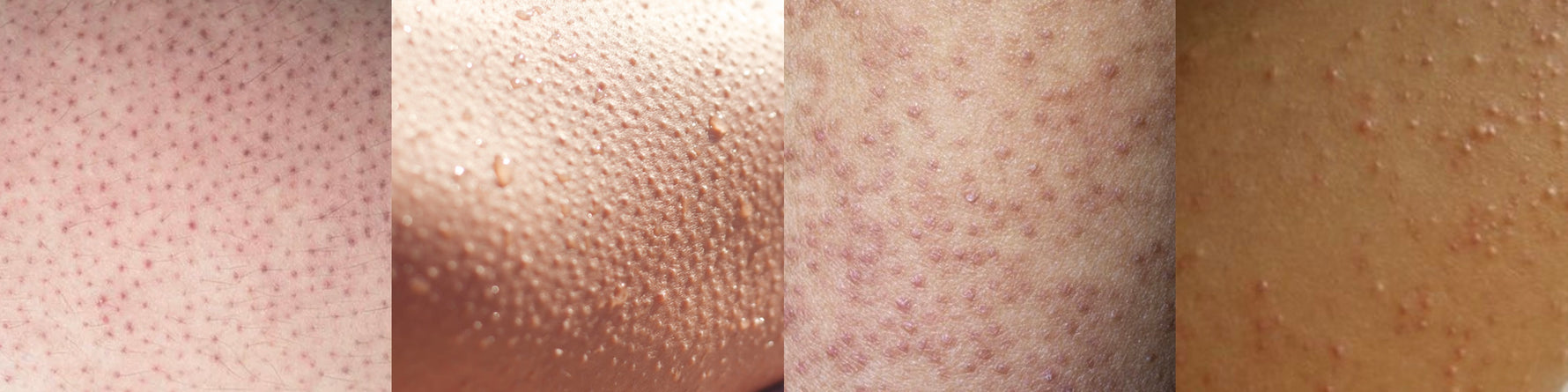 Aspect de la peau avec kératose pilaire