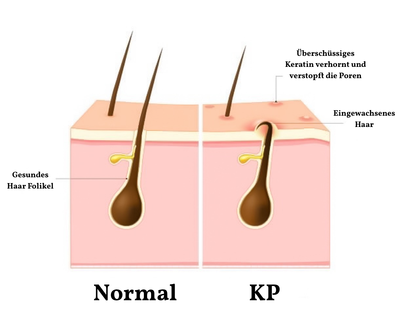Schéma follicule sain vs kératose pilaire